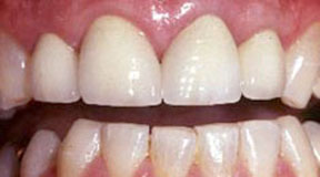 anterior-crowns-after-4