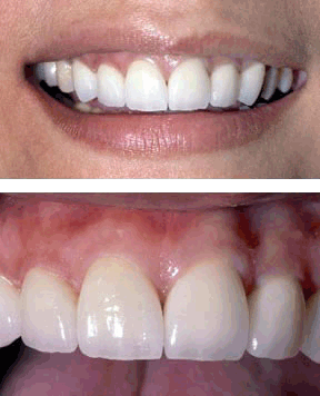 anterior-crowns-after