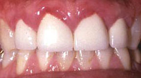 anterior-crowns-before-4