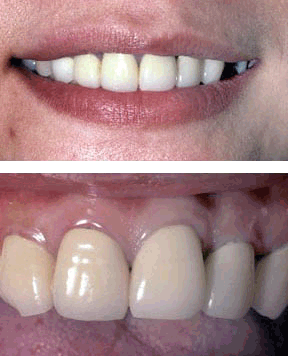 anterior-crowns-before