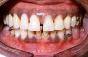 denture-01-after