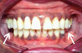 denture-01-before