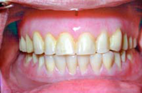 denture-02-after