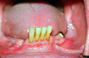 denture-03-before