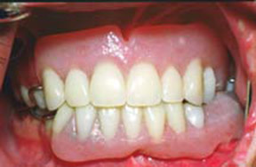 denture-04-after