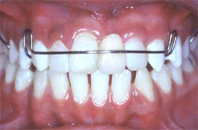 dentures05after