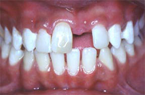 dentures05before