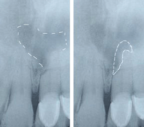 endo5before