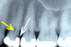 endo_00_before