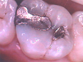 fillings-01-before