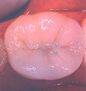 fillings-04-after