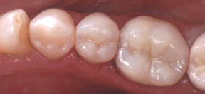 fillings-05-after