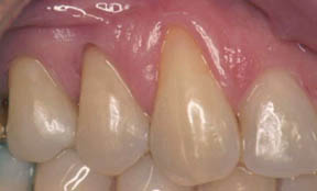 fillings-09-after