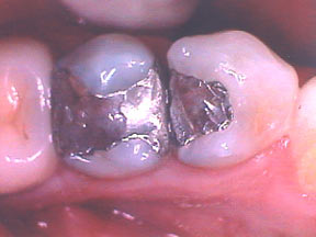 fillings-gallery-before