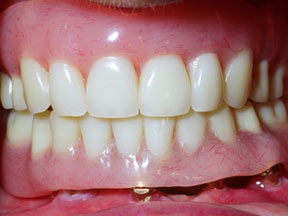 implant-03-after