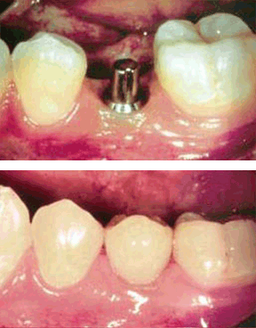 implant-05-after