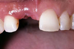 implant_00_before