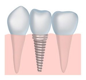 dental implants in Clovis and Fresno