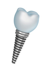 Single tooth dental implant