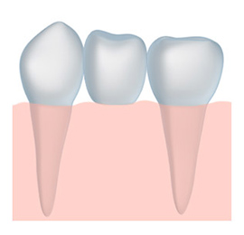 tooth crown dentistry with a Fresno dentist near Clovis