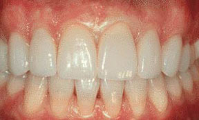 veneers_00_after