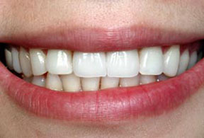 veneers_02_after