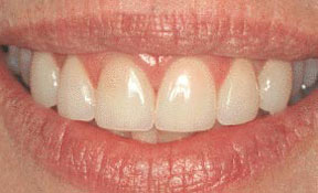 veneers_03_after