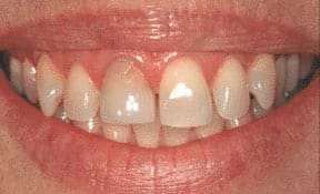 veneers_03_before