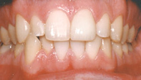 veneers_04_after