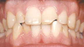 veneers_04_before