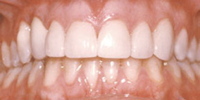 veneers_05_after