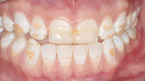 veneers_06_before