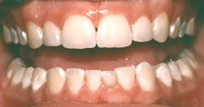 veneers_07_after