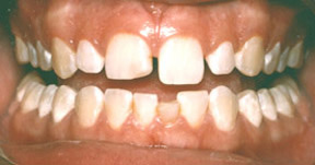 veneers_07_before