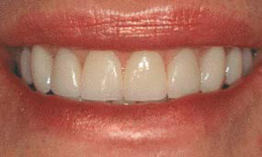 veneers_08_after