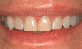 veneers_08_before