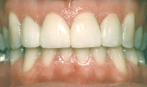 veneers_09_after