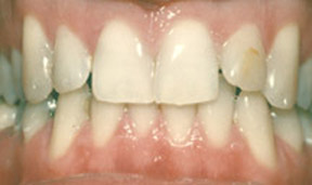 veneers_09_before