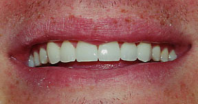 veneers_10_after