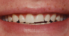 veneers_10_before