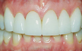 veneers_11_after