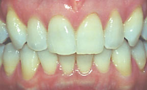 veneers_11_before