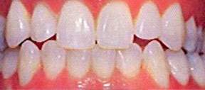 whitening_00_after