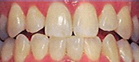 whitening_00_before