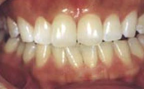 whitening_01_after