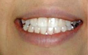 whitening_02_after