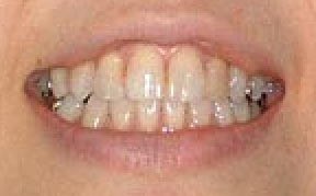 whitening_02_before