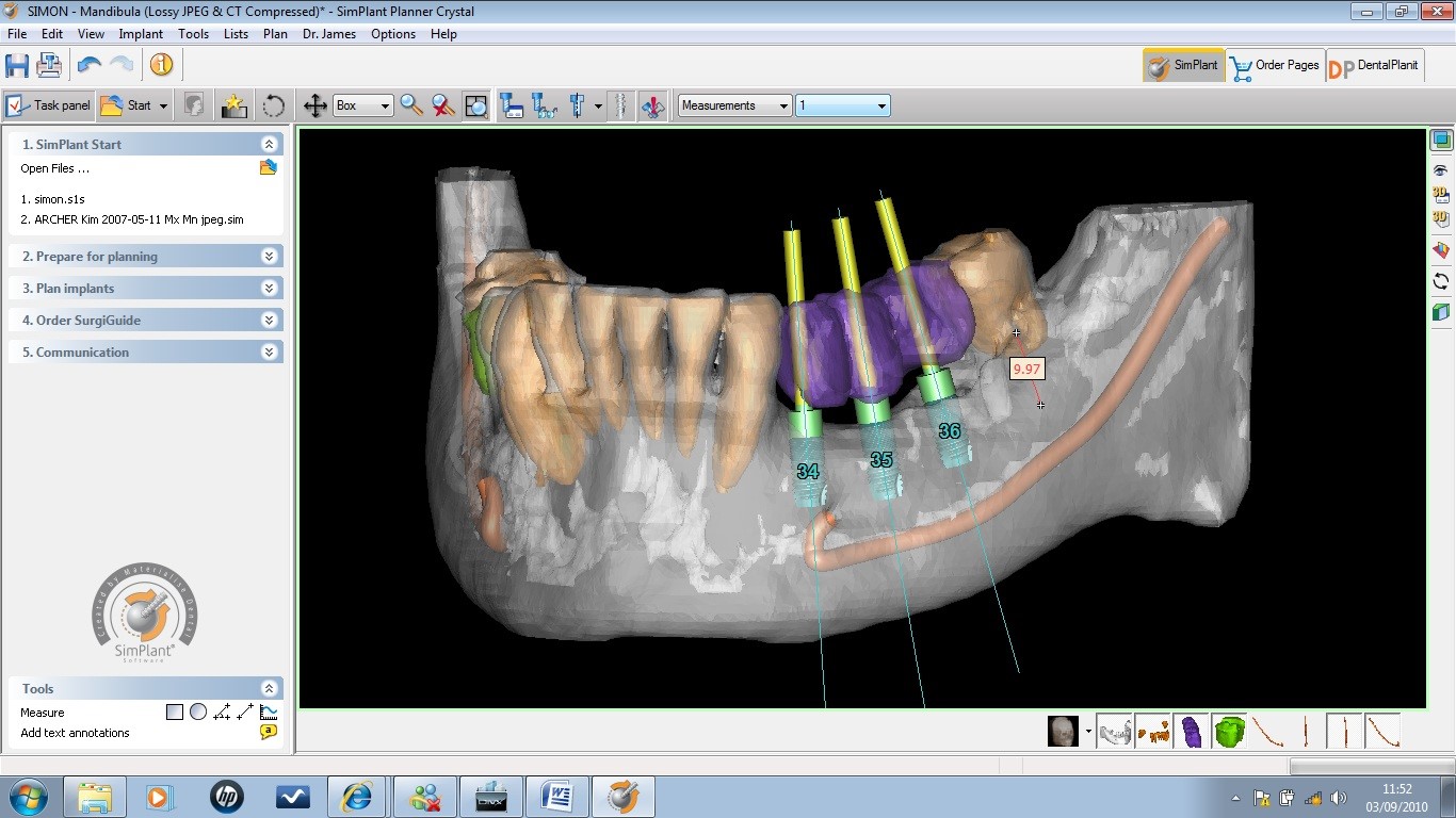 Virtual Surgery Planning Software