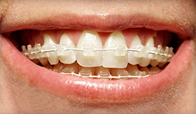 six month smiles clear braces with a Clovis dentist in Fresno CA