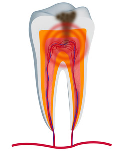 Root canal therapy near Clovis and Madera